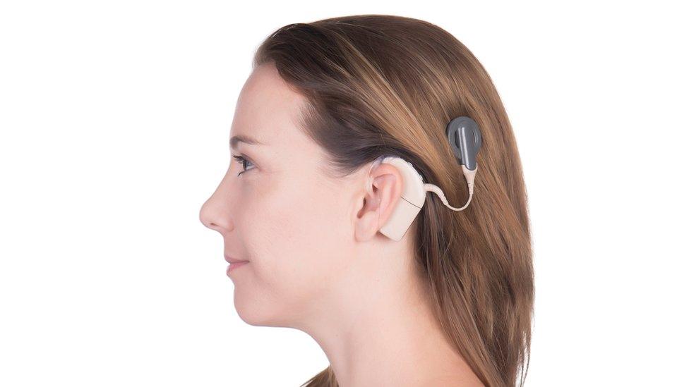 A woman with a cochlear implant